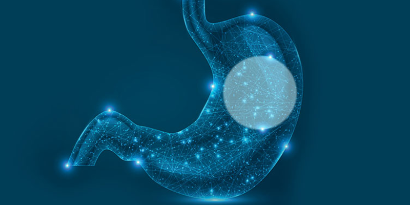 Endoscopic Gastric Balloon