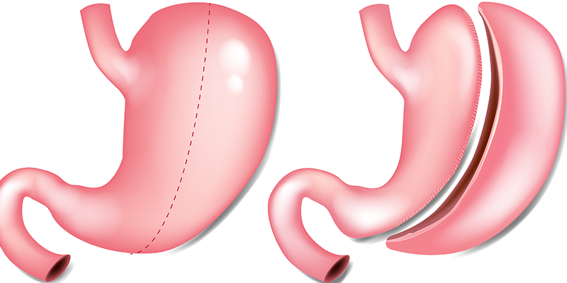Sleeve Gastrectomy (Stomach Tube)