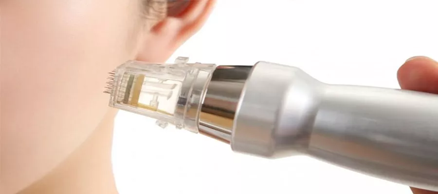 Altın İğne (Fraksiyonel Radyofrekans)