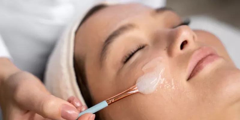 Kimyasal Peeling